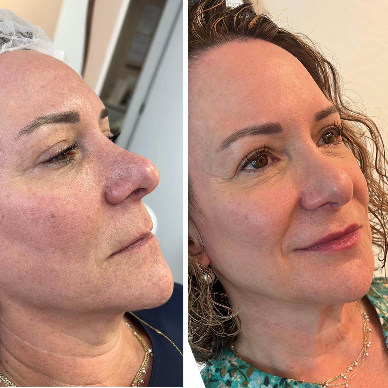 Resultado de harmonização facial — Dra. Simone Benko