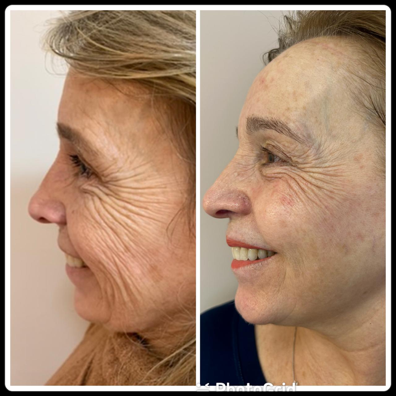 Resultado de bioestimuladores — Dra. Simone Benko