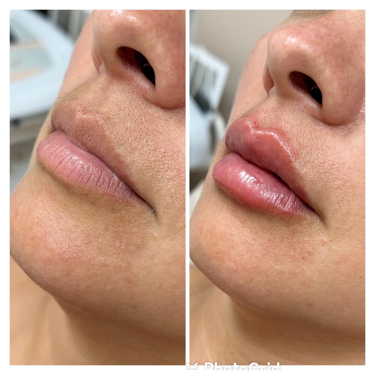 Resultado de rejuvenescimento — Dra. Simone Benko